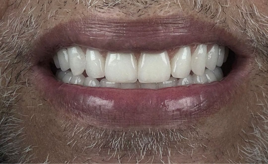 Sorriso reabilitado com prótese fixa sobre implante, em caso conduzido pelo Dr. Thierry Bernardo